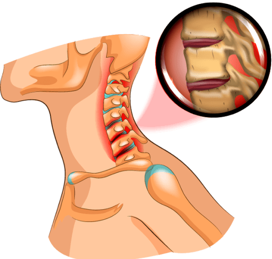 osteocondrosis in the neck