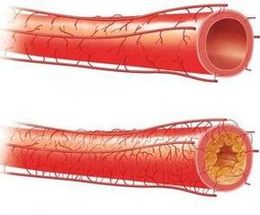 With a weak patension with a developed stage of normal ship and cervical osteocondrosis