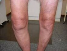Symptoms of arthrosis of the knee joint