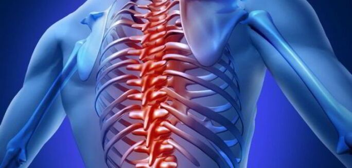 osteochondrosis of the thoracic spine